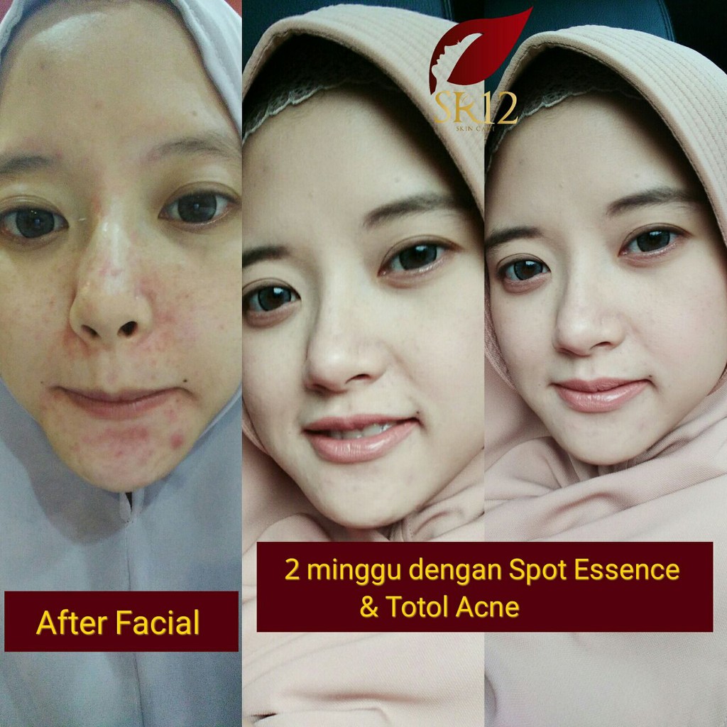 SR12 Acne Totol - Perawatan Jerawat - Menghilangkan dan Menyamarkan - SR12 Skincare - Skin Care