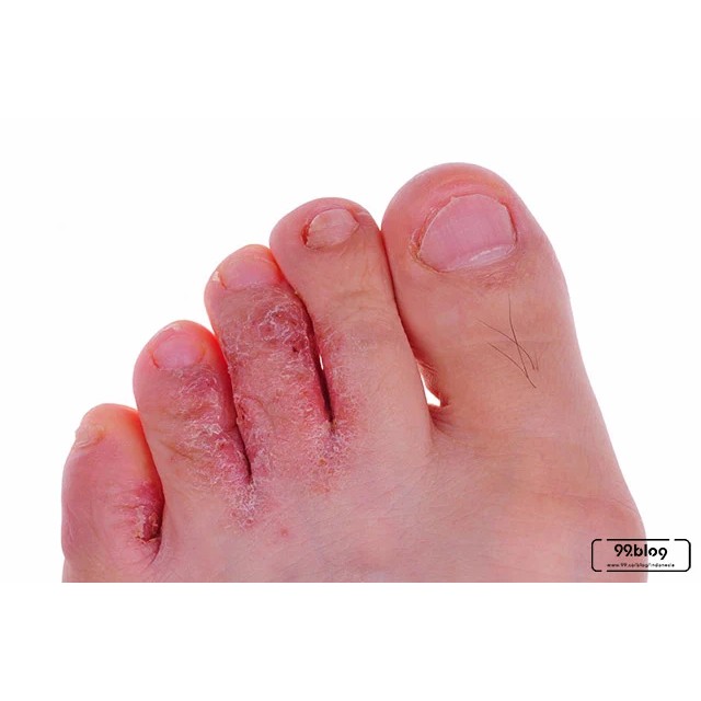 alep China Cream Anti Jamur Panu Kadas Kudis Kurap Kutuair Herpes eksim Kering Basah Gatal Alergi