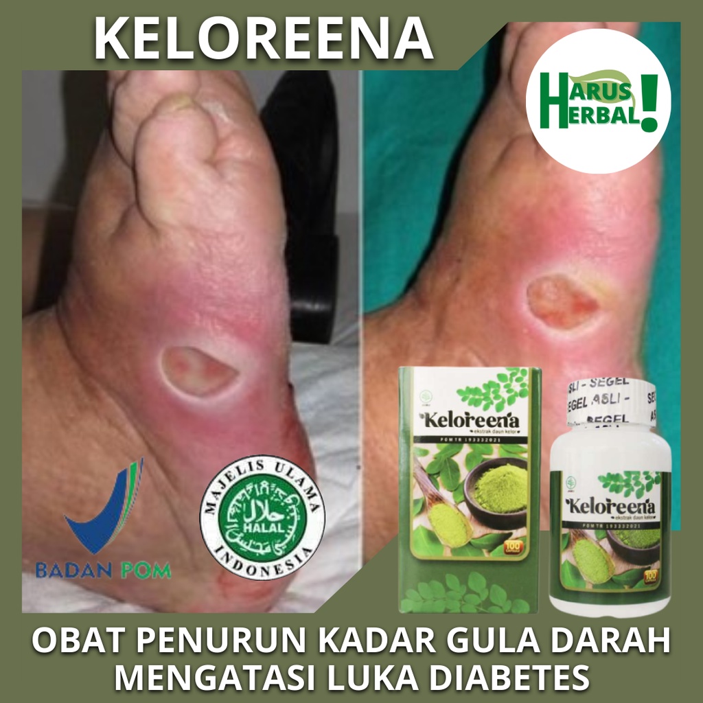 Obat Diabetes Alami, Obat Penurun Kadar Gula Darah, Obat Luka Diabetes, Obat Kencing Manis, Obat Pen