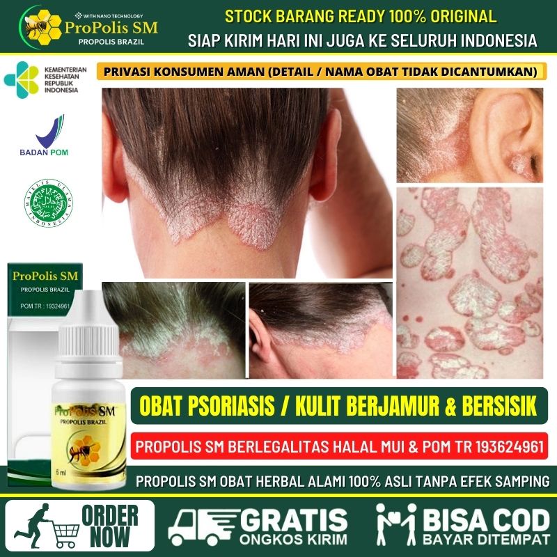 Salep Psoriasis di Kulit Kepala / Wajah Muka / Kaki / Bibir / Telapak Tangan - Obat Psoriasis, Pengh