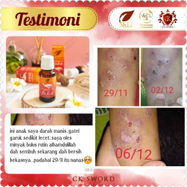 Terampuh Alergi Luka Nanah Gatal Gatal Indonesia