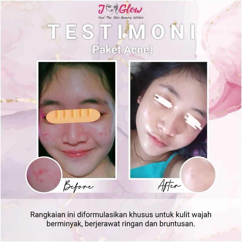 Jglow Skincare Paket Acne Whitening Skin Cream glowing(Menyembuhkan beruntusan serta jerawat ringan)