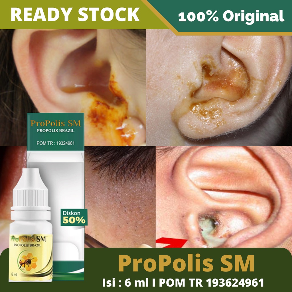 Propolis SM Brazil - Obat Tetes Kotoran Telinga Keras - Penghancur Kotoran - Obat Telinga Curek Berair dan Bau - Obat Tetes Telinga Alami Berkhasiat Herbal - Pembersih Kotoran Telinga Herbal Tinnitus Tuli