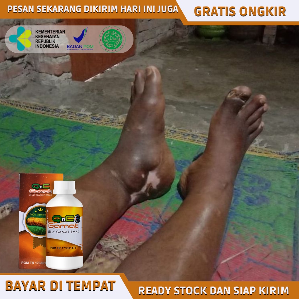 Obat Pengering Luka Diabetes, Obat Luka Diabetes Bernanah, Obat Diabetes Melitus, Obat Luka Diabetes