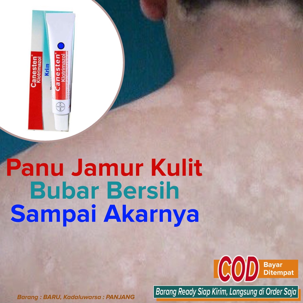 Salep Obat Pembersih Panu Penghilang panu Bandel AMPUH ~ Canesten Krim 10g