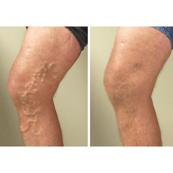 Salep Parises Herbal Varicose Veins Treatment