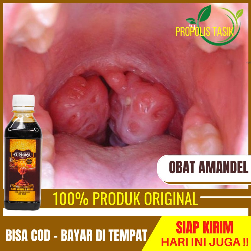 Obat Amandel - Radang Amandel - Sakit Tenggorokan - Amandel  Anak - Amandel Bengkak - Amandel Kronis