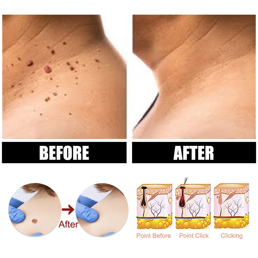 SKIN TAG Penghilang Kutil dan Tahilalat Obat Kutil Obat Merontokan Kutil Kemaluan Penghilang 10ml