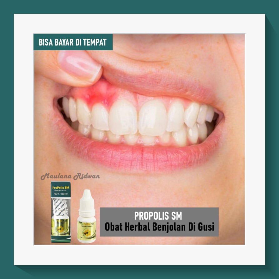 Obat Benjolan Di Gusi, Infeksi Gusi, Gusi Berdarah, Sakit Gusi, Obat Gusi Bengkak Propolis SM