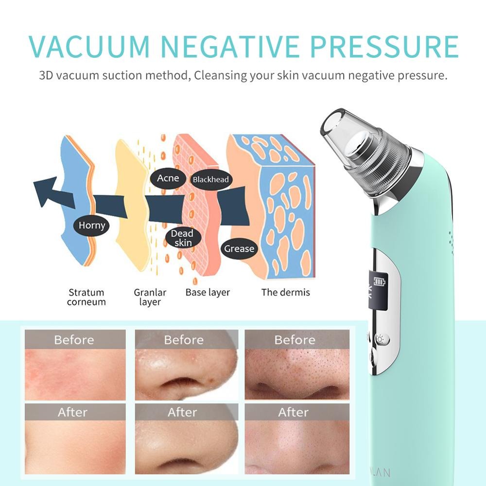 Penghisap Komedo Vacuum Suction Skin Face Care Blackhead Pore Cleaner - ALHTY07-06