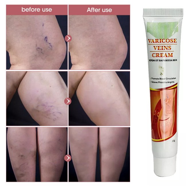 OBAT CREAM HILANGKAN VARISES SEMBUH PERMANEN - CREAM VARICOSE VEINS