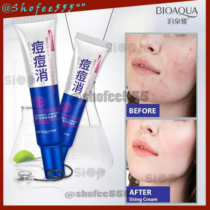 D49 BIOAQUA Anti Acne Oil Control Acne Scar Remove Beauty Cream krim anti jerawat