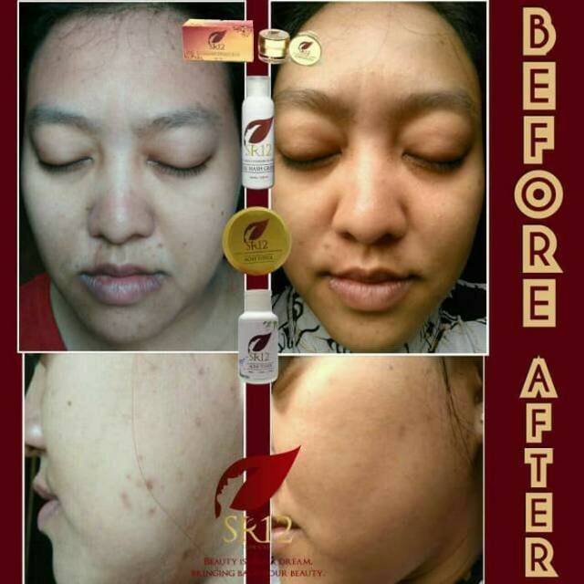 Pembersih Make up acne toner SR12 BPOM ORIGINAL