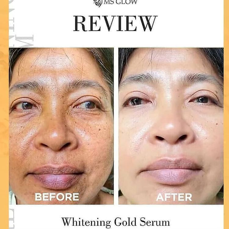 Ms Glow Whitening Gold Serum Ms Glow Original 100% Serum Antiflek Dan Noda Hitam 10X Lipat Mencerahkan Ms Glow