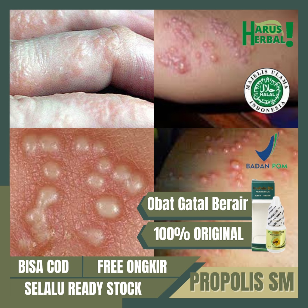 Jual Propolis Sm Obat Kulit Gatal Berair Di Jari Obat Bintik Berair Di Tangan Beruntusan 2975