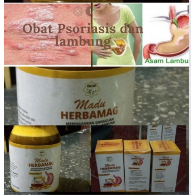 Obat Herbal Psoriasis dan Lambung