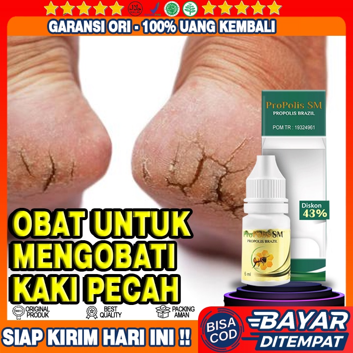 Obat Kaki Pecah Pecah, Obat Kaki Pecah2, Tumit Pecah2, Obat Oles Kaki Rayapan, Obat Kaki Rayapan