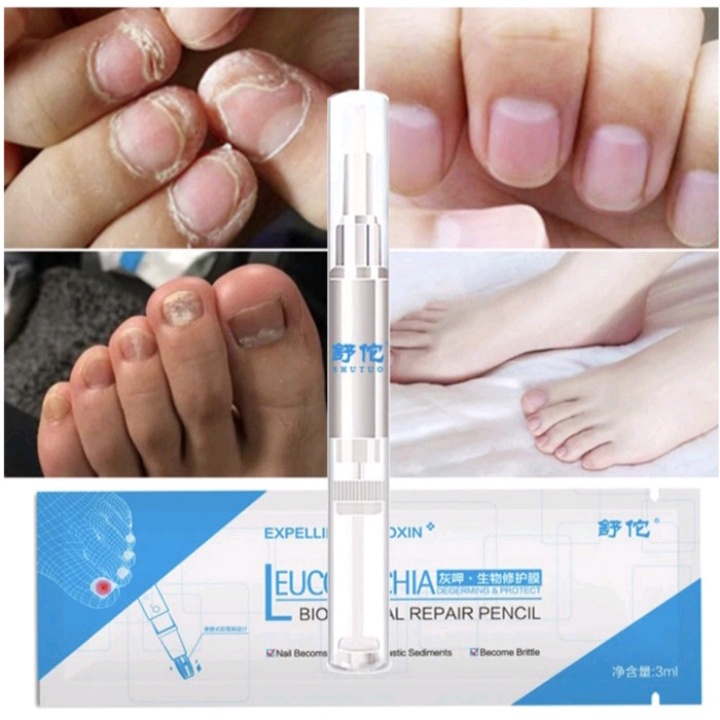 [BISA COD] Leuconychia Biological Repair Pencil Obat Anti Jamur Bakteri Kuku Rusak Perawatan Infeksi Kuku Sakit