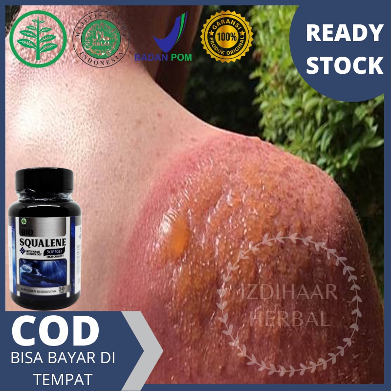 Obat Luka Bakar - Obat luka bakar melepuh - Obat herbal luka bakar - Obat pengering luka - Obat luka