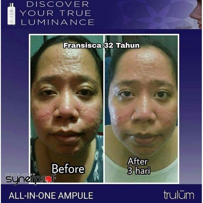 Perawatan Tubuh - Kecantikan - Perawatan Kulit Distributor Trulum Synergy - Atasi Jerawat Secara