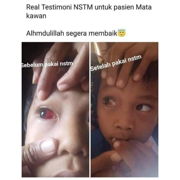 NSTM untuk mata merah mata katarak sakit mata mata bengkak/ alami dan herbal