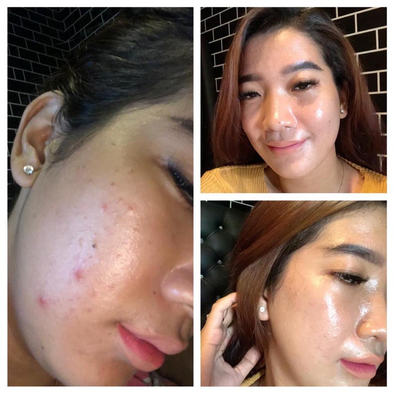 {BANYAK GIFT} BENINGS SKINCARE BRIGHTENING DAN ACNE (bening’s clinic)