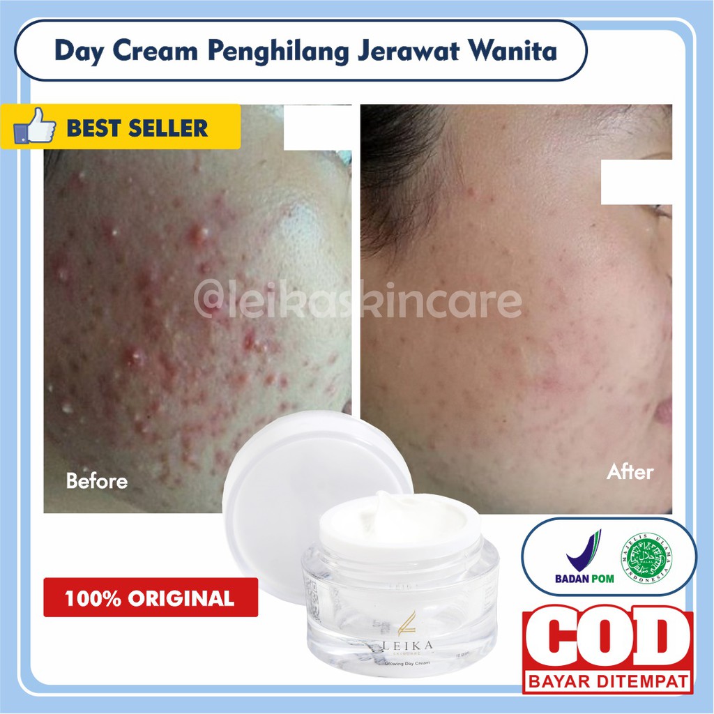 [DAY CREAM] Krim Penghilang Jerawat Dan Bekas Jerawat Wanita Ampuh Penghilang Jerawat Dan Bekasnya P
