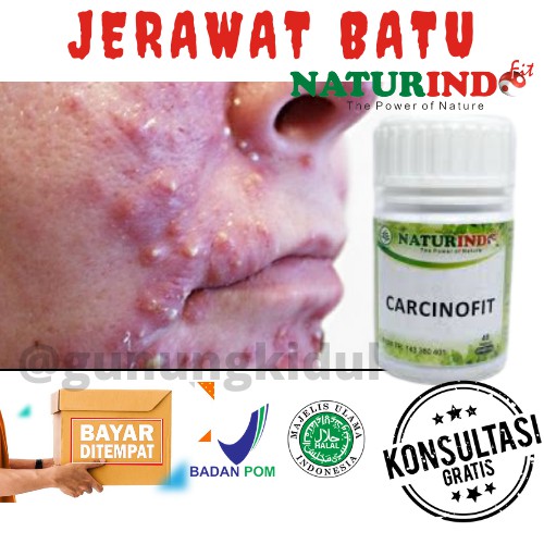 OBAT HERBAL BENJOLAN KANKER TUMOR BISUL JERAWAT BATU LIPOMA UCI UCI HERBAL CARCINOFIT NATURINDO COD-3