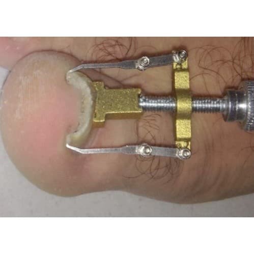 Ingrown Toe Nail Correction Tool Pedicure Tool