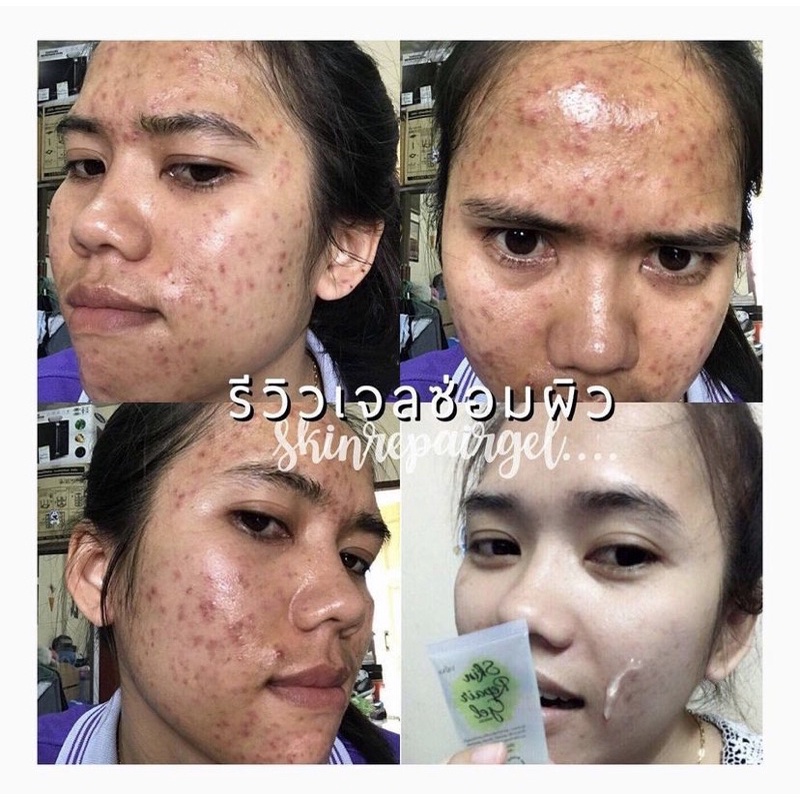 🇹🇭 Erika Skin Repair Gel 42ml / pelembab dan eye cream kulit jerawat / anti acne