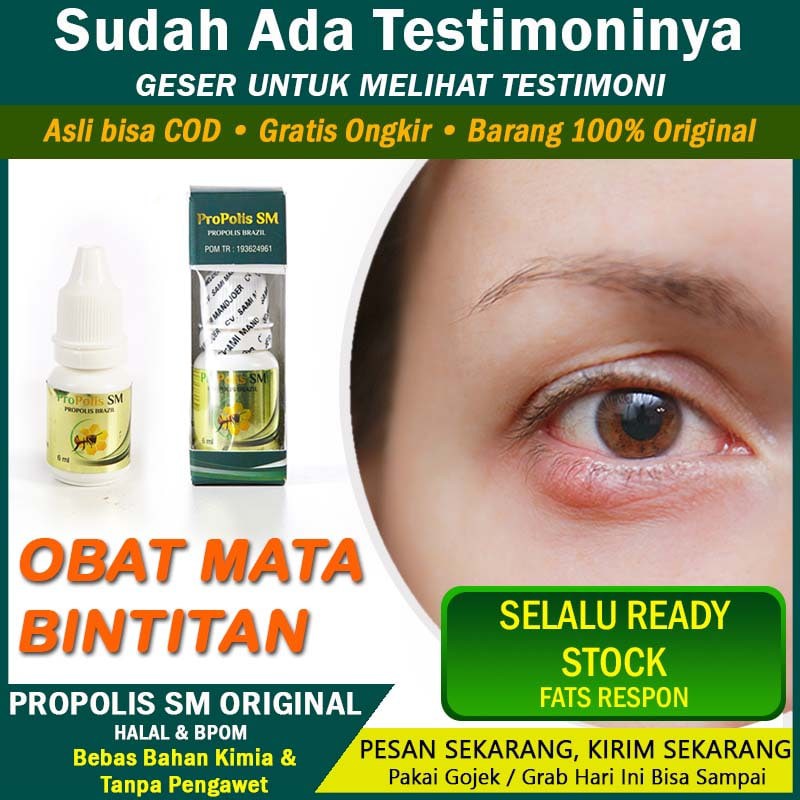 Obat Kalazion Mata Bintitan Pada Anak Bisul Di Kelopak Mata Penghilang Bintil Mata Propolis Sm Shopee Indonesia