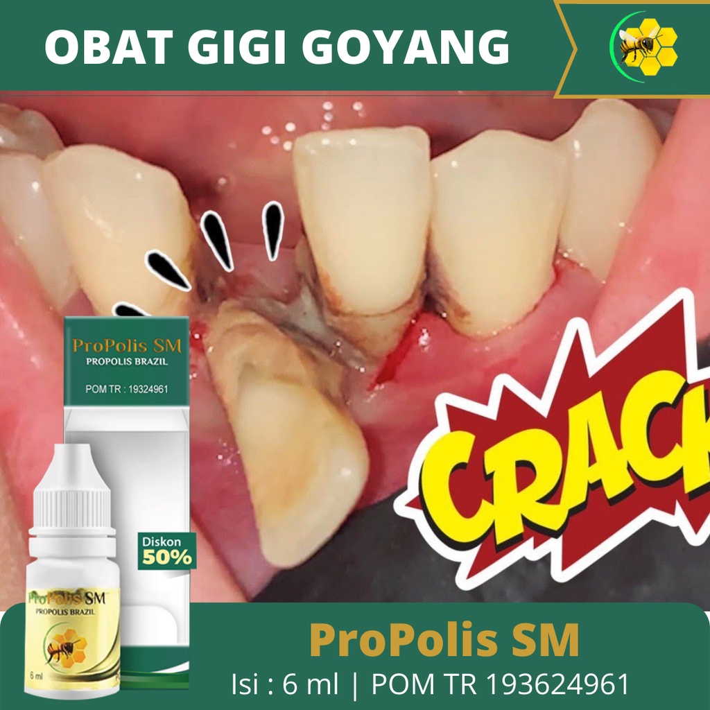 Obat Gigi Goyang Agar Copot - Obat Sakit Gigi Nyut Nyutan - Obat Perontok Gigi Berlubang - Obat Gigi