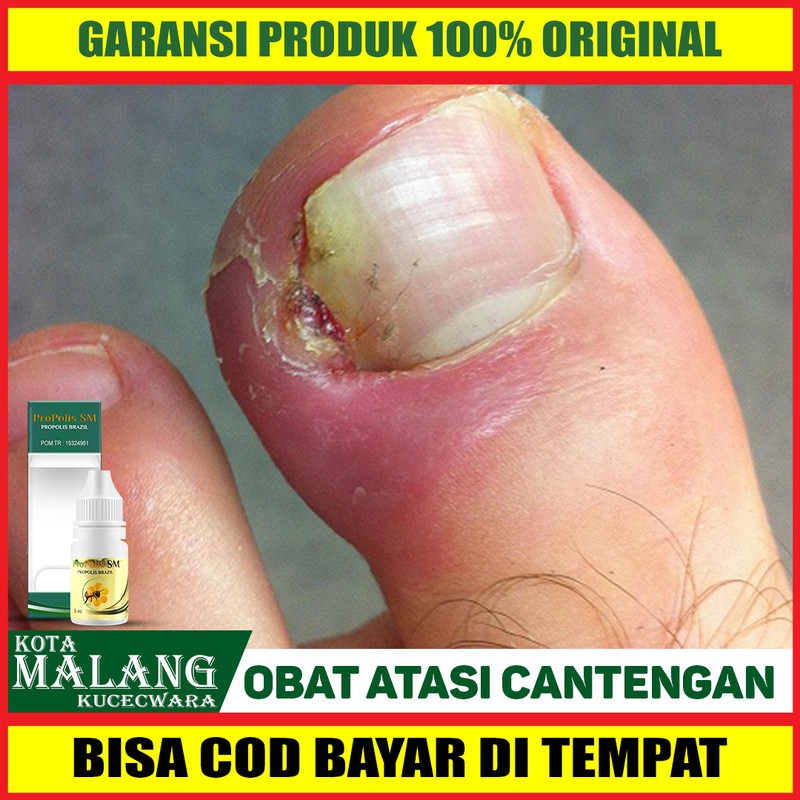 Obat Cantengan Jempol Kaki, Kuku Jempol, Busuk, Centengan PROPOLIS SM Asli di Malang Bisa COD