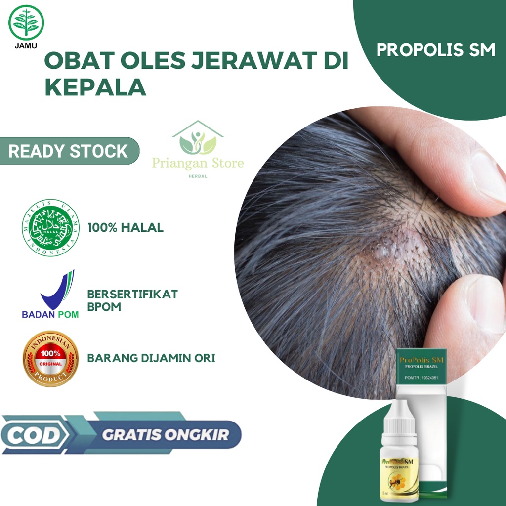 Obat Jerawat di Kulit Kepala, Obat Benjolan Bernanah di Kepala, Obat Cenang di Kepala, Obat Bisul di