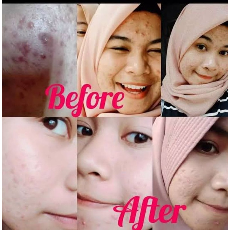 Paket Radiant Acne/Kulit Berjerawat aktif/Bernanah DRW SKINCARE BPOM