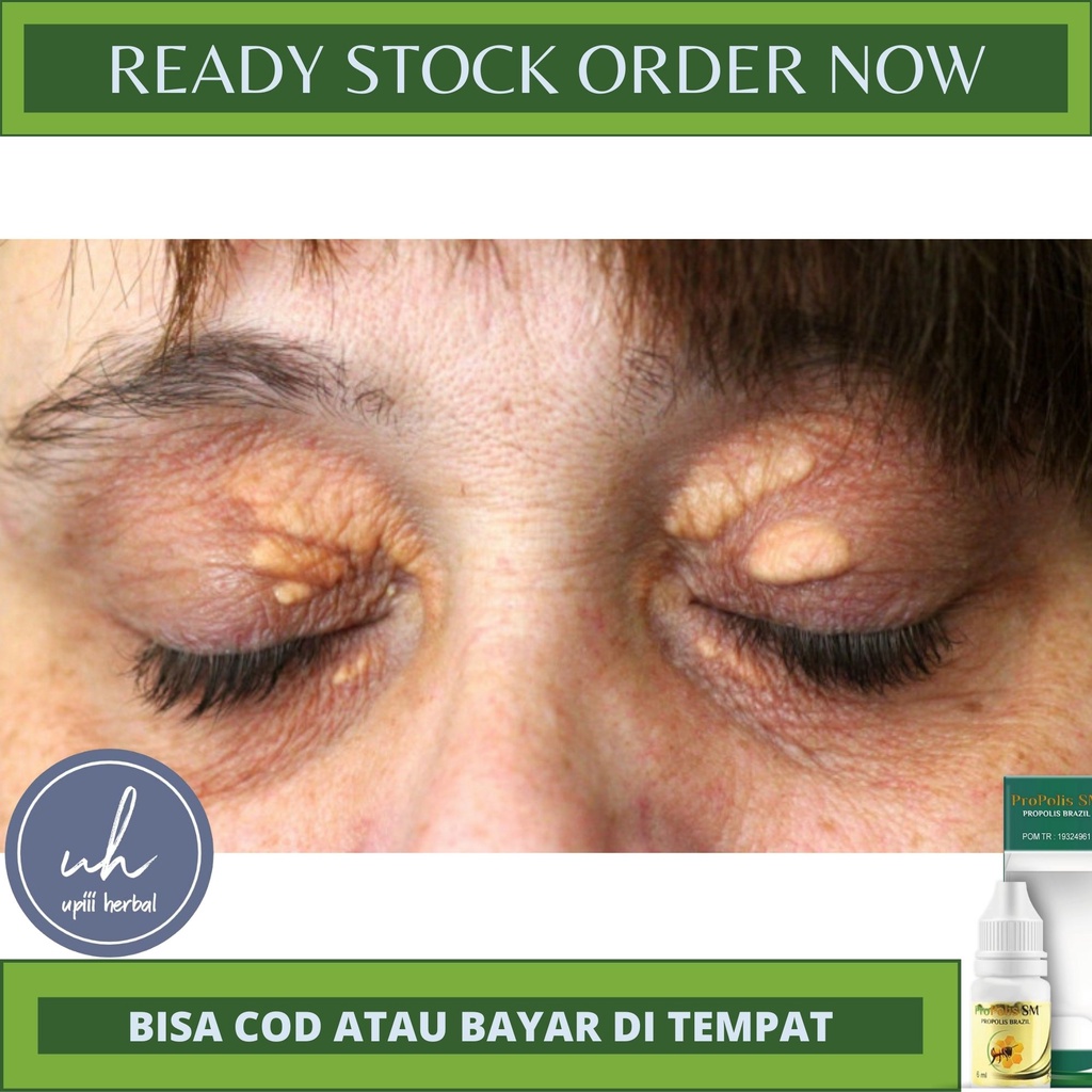 OBAT PENGHILANG XANTHELASMA MATA,PENGHILANG LEMAK BERLEBIH DIKELOPAK MATA,OBAT HERBAL XANTHELASMA,OB