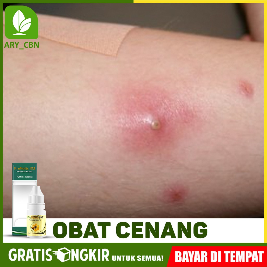 

Obat Cenang, Bisul Telur Kodok, Benjolan Bernanah, Budug Propolis SM Brasil Bisa COD Di Cirebon