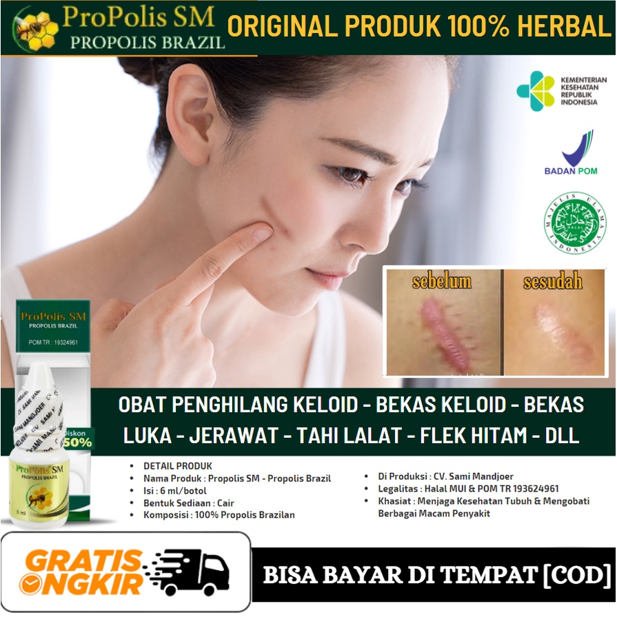 Obat Untuk Keloid Bernanah, Keloid Jadi Hitam & Keras, Keloid Gatal, Keloid Berair, Propolis SM Asli