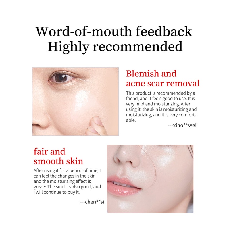 Youbuy Whitening Freckle Cream Remove Dark Spots Anti Freckle Cream Niacinamide Fade Pigmentation Melasma Brighten Creams