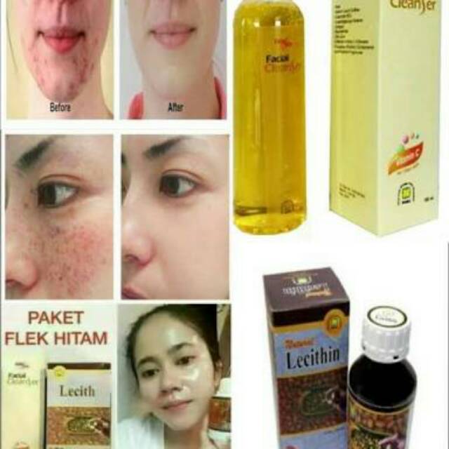 Original 100 Herbal Nasa Paket Flek Hitam Membandel Bekas Jerawat Bekas Luka Shopee Indonesia