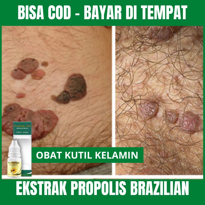 Obat Kutil Kelamin, Gatal Kelamin Pria, Infeksi Jamur Miss V, Penghilang Kutil Papiloma, Jengger Aya