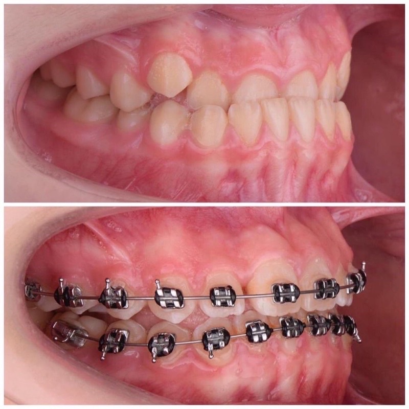 Behelldental - PAKET BEHEL PERMANEN PERBAIKIN GIGI TIPE BRACKET FDA MIM ROTH HIGH QUALITY - Kawat Dental Geousis Luxury With Hook 0.22 Perawatan Gigi Mini Metal Ortho Braket Braces Original