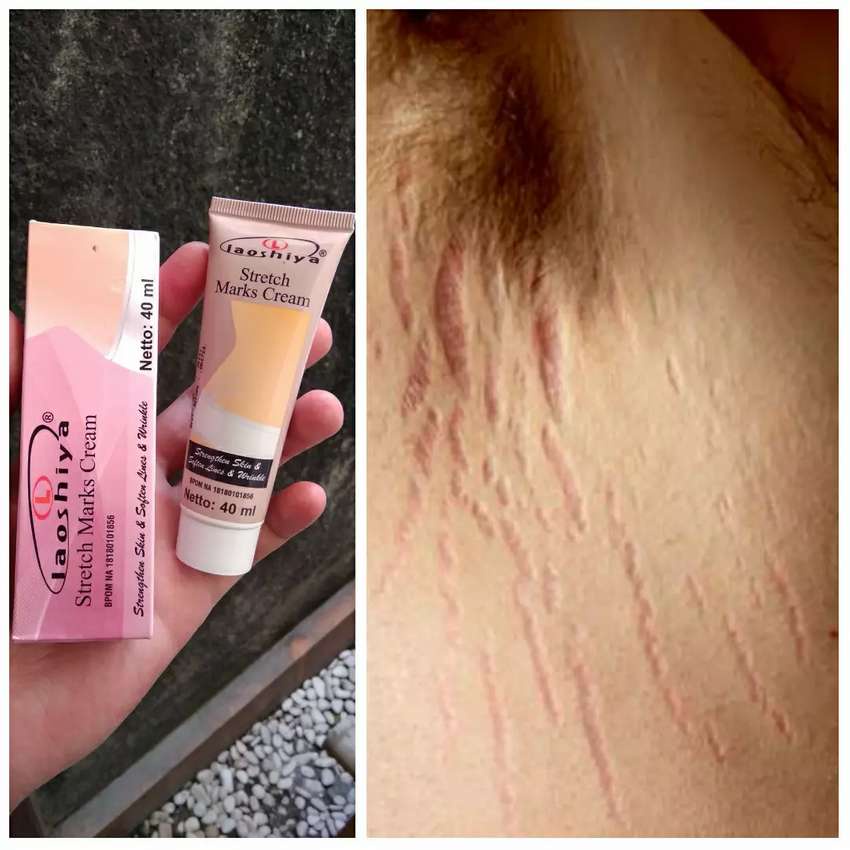 [COD] Krim Ampuh Penghilang Stretch Marks - Laoshiya Cream 40ml ORIGINAL BPOM Menyamarkan atau Menghilangkan Stretch Marks Garis Halus Pasca Melahirkan Penurunan serta Kenaikan Berat Badan