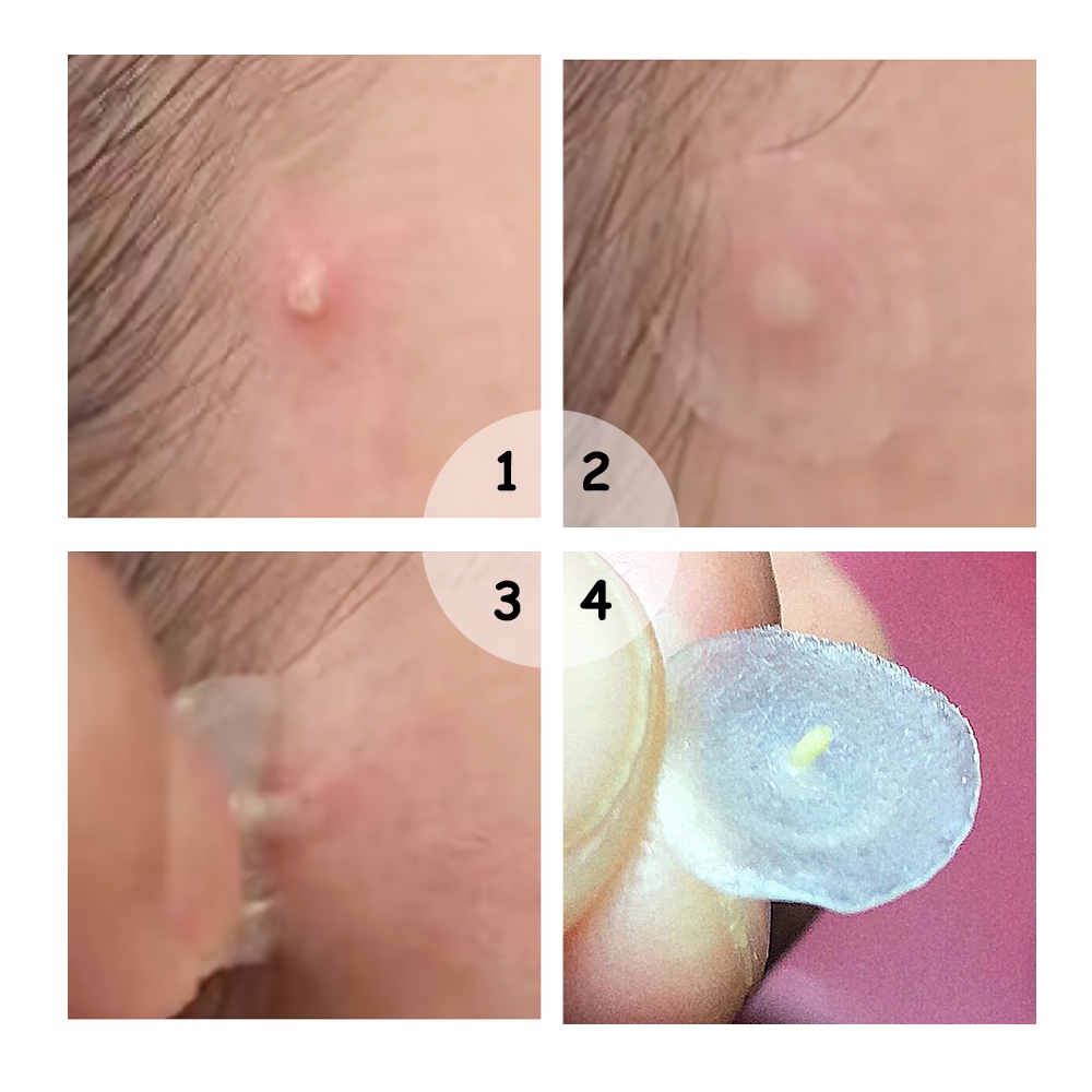 [Grosir] Allphv Acne Patch Pimple Removal Penghilang Jerawat Day Use 0.1mm and Night Use 0.3mm Acne Treatment Ready Stock(22 sticker jerawat)