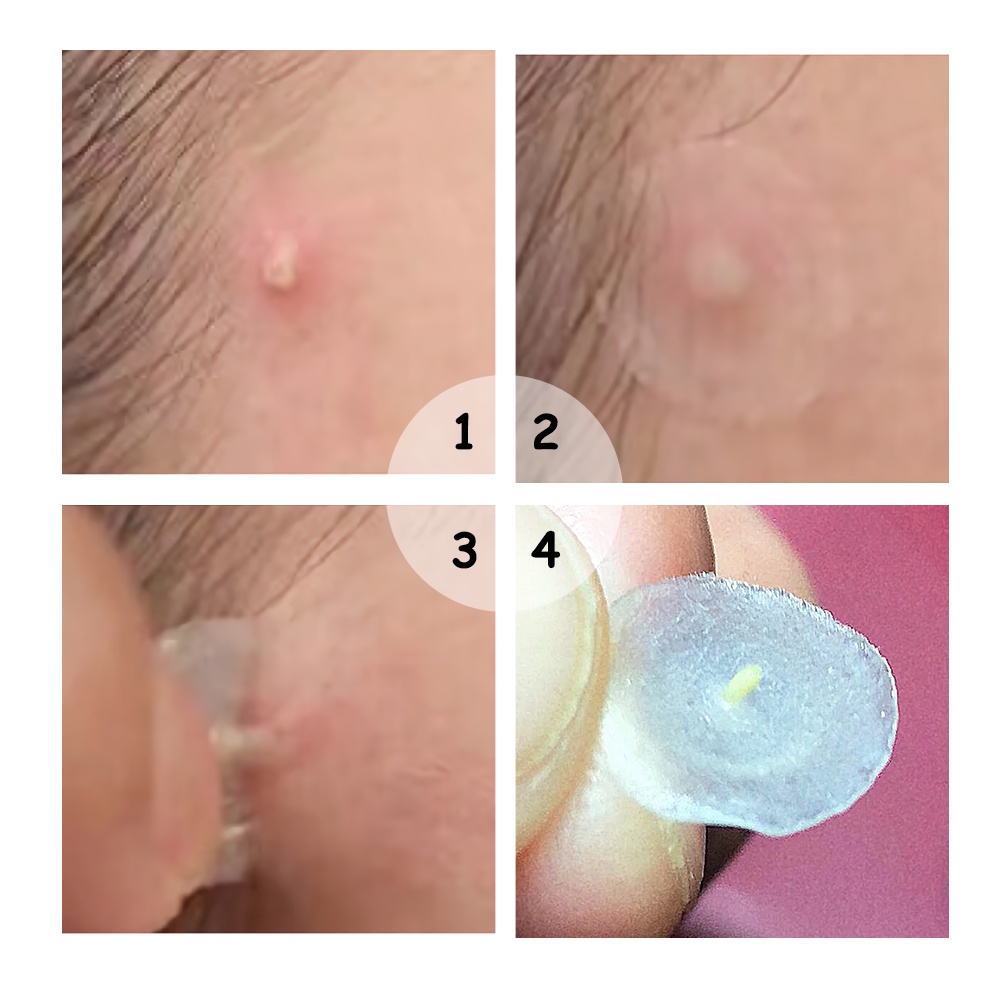 [Ori100%]Allphv Acne Patch Pimple Removal Penghilang Jerawat Day Use 0.1mm and Night Use 0.3mm Acne Treatment Ready Stock(22 sticker jerawat)