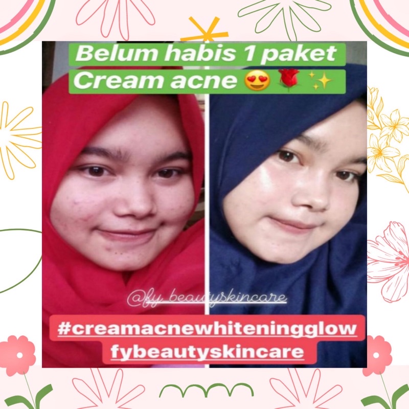 ( FYBEAUTY ) Cream Acne Super Whitening Glowing 100% Ampuh Original