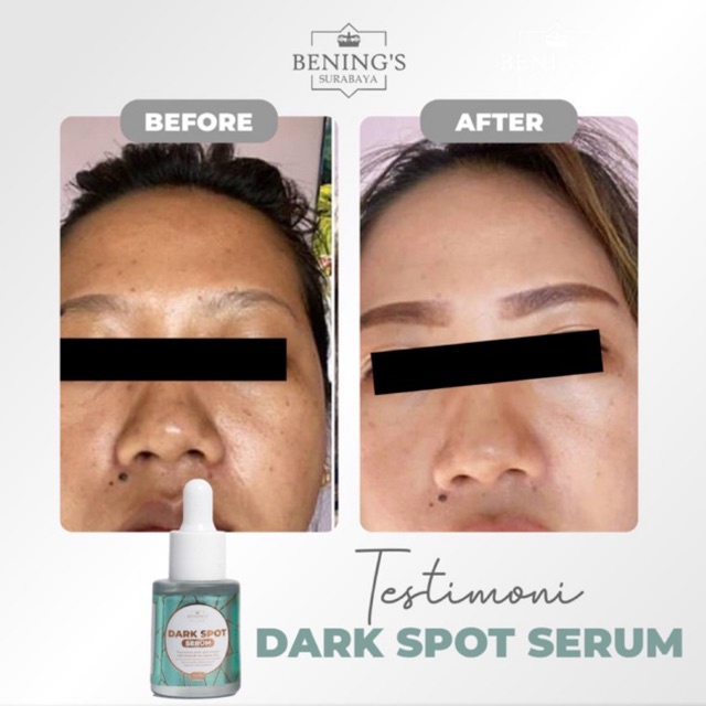 BENING'S SERUM DARK SPOT | MENGATASI FLEK, MELASMA &amp; MENCERAHKAN | FREE GIFT SIAP KIRIM SELURUH INDONESIA