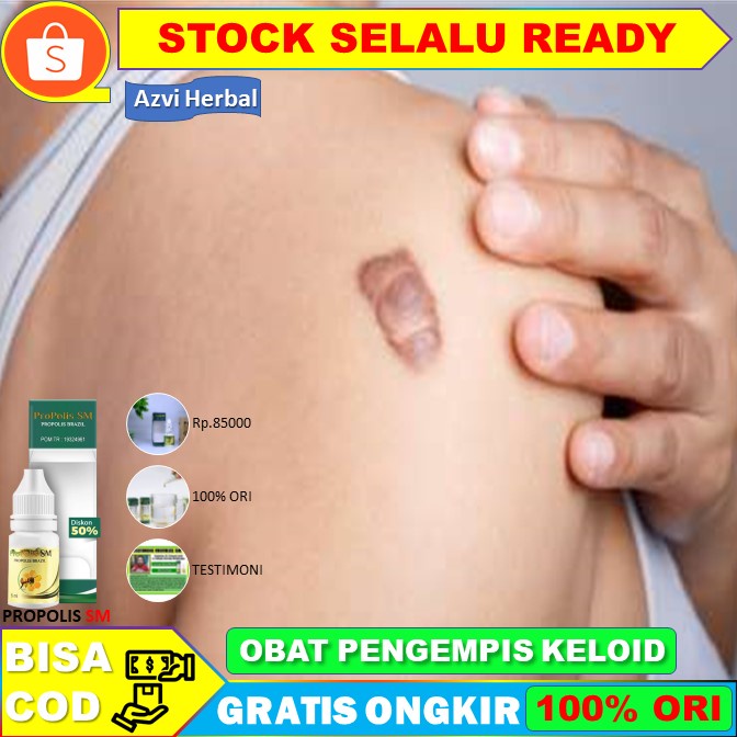 Obat Penyakit Kulit Keloid Terbukti Khasiatnya - Propolis SM Brazil Asli