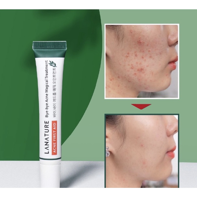 Lanature-Bye-bye Acne Magical magical Treatment  spot cream Hilangkan Jerawat/ LA NATURE ANTI ACNE
