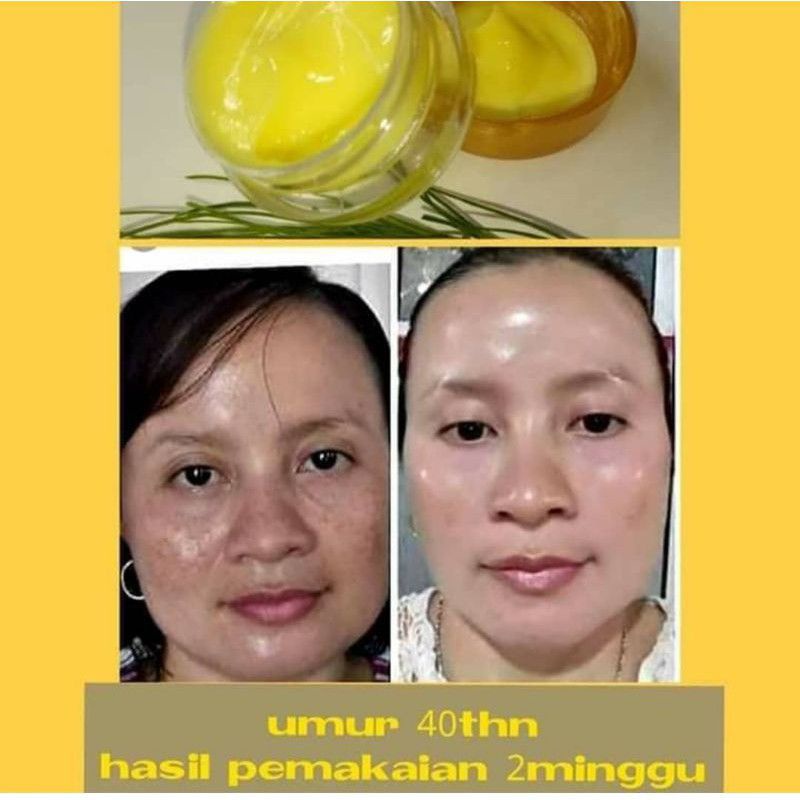 Salep Cream Flek Hitam membandel - melasma flek menahun